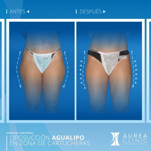Liposucci�n Agualipo Cartucheras
